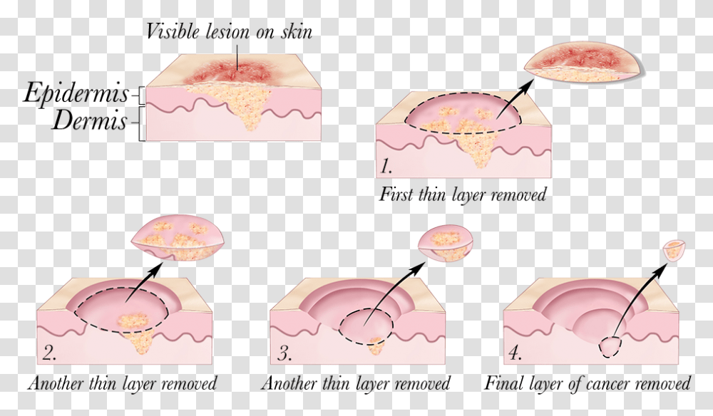 2010 Terese Winslow Skin Cancer Treatment, Diagram, Box Transparent Png