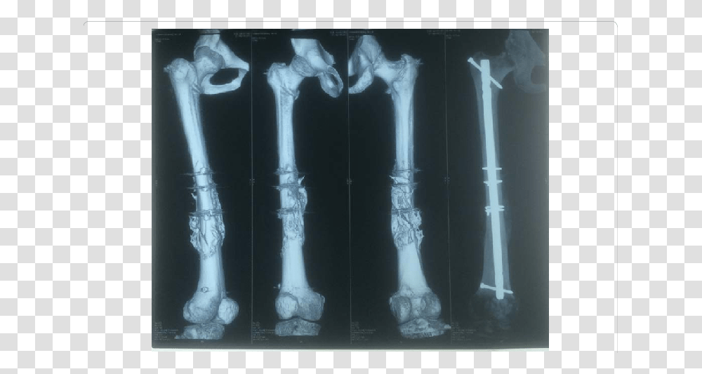 3d Ct Scan And X Ray Of Femur With Accelerated Union 3d Ct Femur, X-Ray Transparent Png
