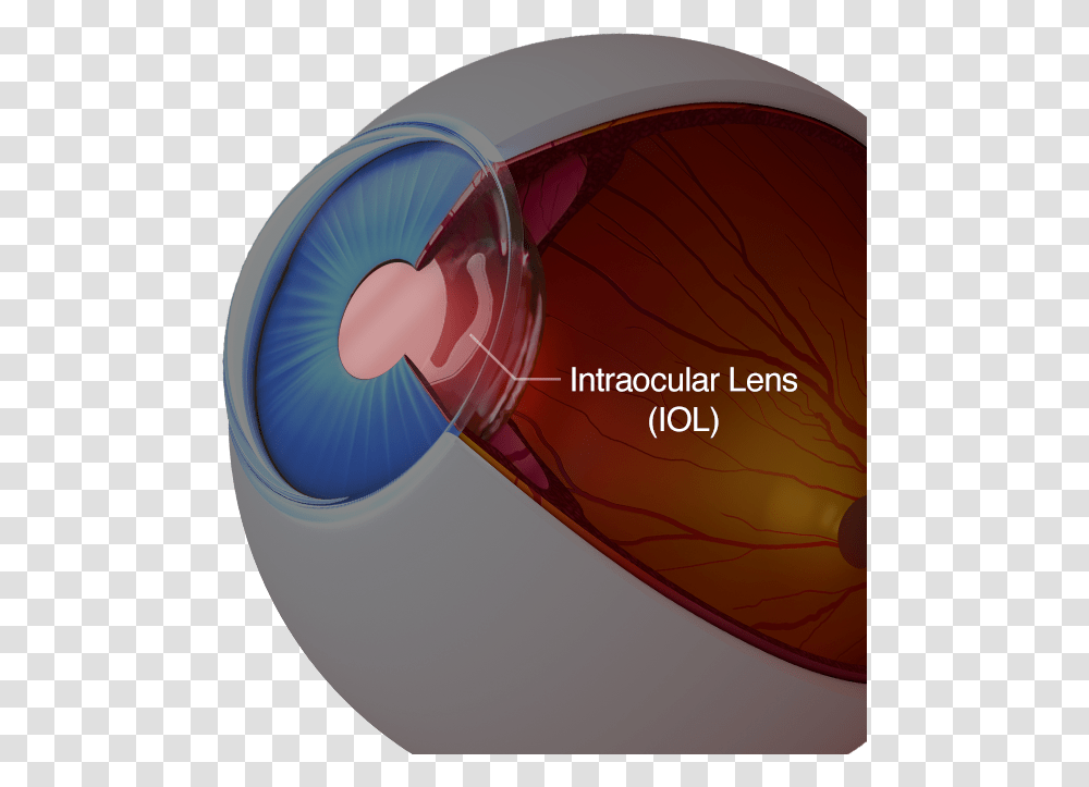 A Diagram Of An Eye With An Intraocular Lens Intraocular Lens, Glass, Helmet, Apparel Transparent Png