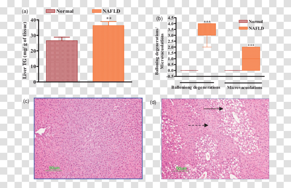 A Elevation In Liver Triglyceride Tg Levels By Dietary Screenshot, Purple, Collage, Poster, Advertisement Transparent Png