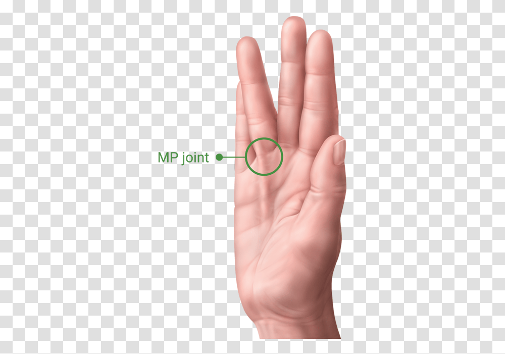 A Hand With Dupuytrens Contracture Showing The Pip Facts On Hand Dupuytren's Contracture, Wrist, Person, Human, Finger Transparent Png