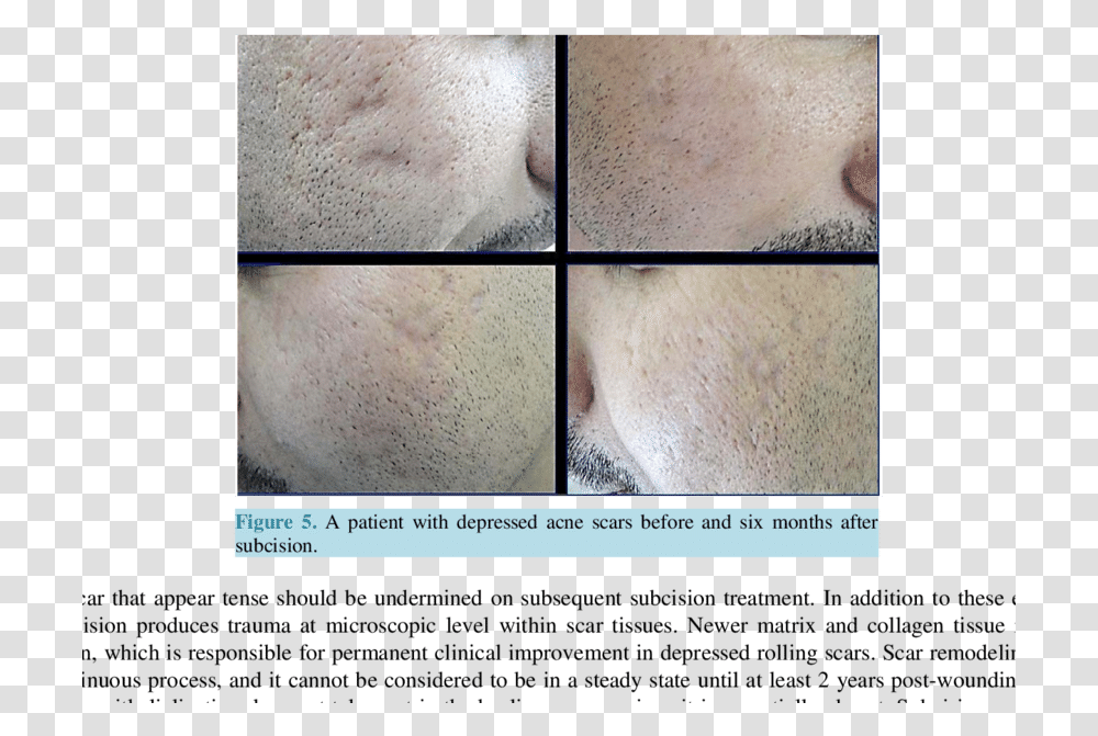 A Patient With Rolling Amp Icepick Acne Scars Before Subcision On Trauma Scars, Skin, Collage, Poster, Advertisement Transparent Png