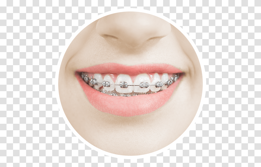 A Woman Smiles Happily With Metal Braces On Her Increasingly Smiles With Gold Braces, Teeth, Mouth, Lip, Person Transparent Png