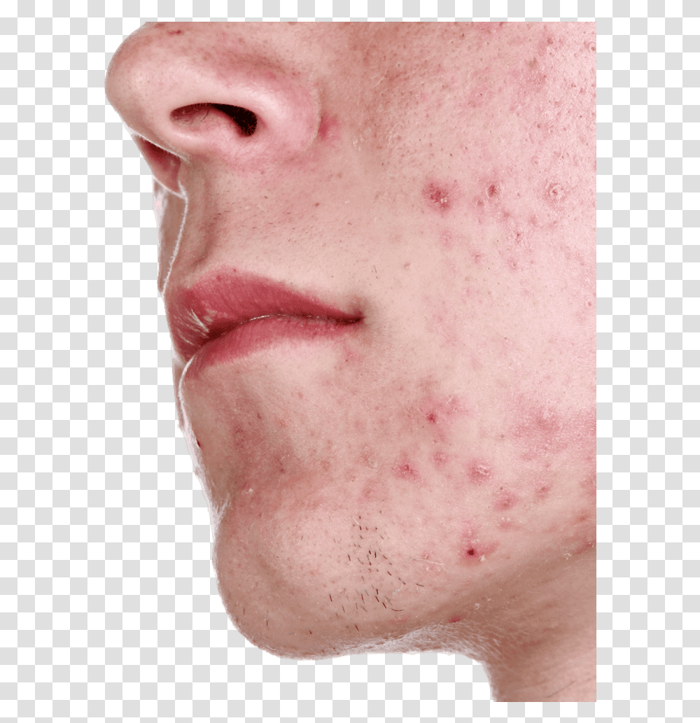 Acne Acne Images Free Download, Skin, Face, Person, Human Transparent Png