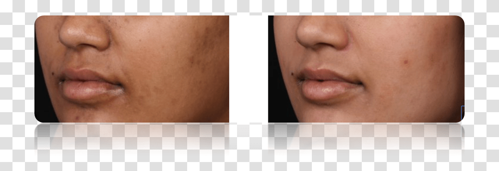 Acne Scar, Face, Person, Human, Jaw Transparent Png