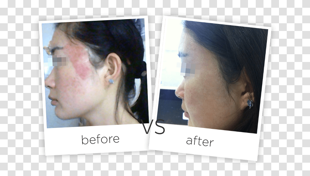 Acne Scars Treatment Adss Laser Number, Face, Person, Jaw, Head Transparent Png
