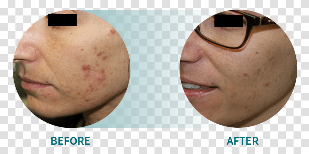 Active Acneacne Scars, Skin, Face, Person, Human Transparent Png