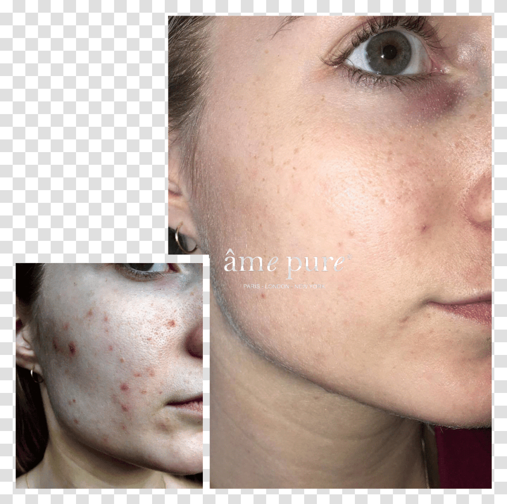 Ame Pure Before And After, Face, Person, Human, Skin Transparent Png