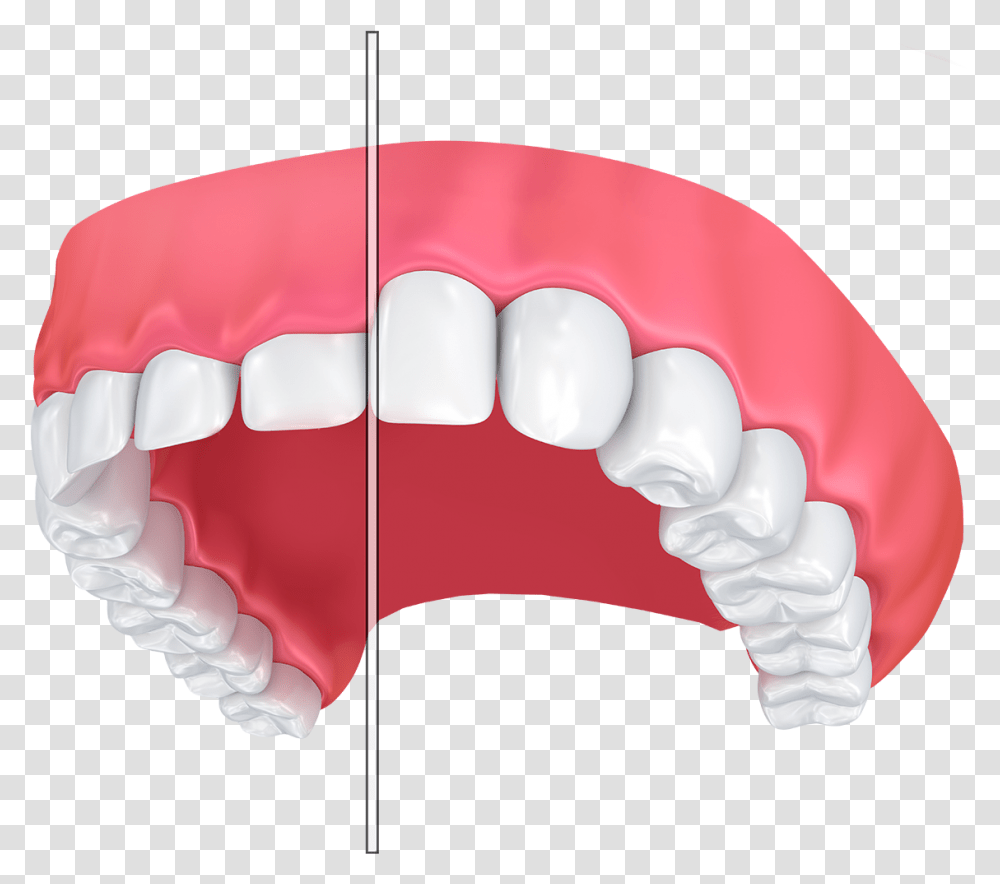 An Illustration Of Before And After Laser Gum Contouring Estetik Dolgu, Teeth, Mouth, Lip, Jaw Transparent Png