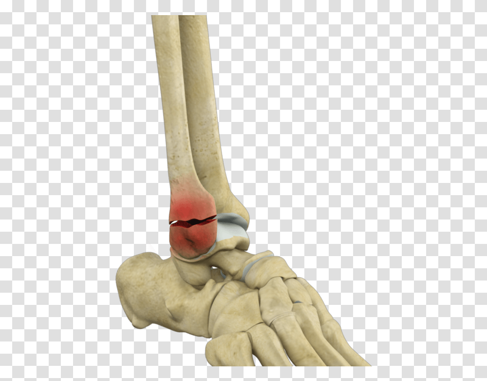 Ankle Fracture Repair Los Angeles Fractured Ankle, Person, Human, Figurine, Sunglasses Transparent Png