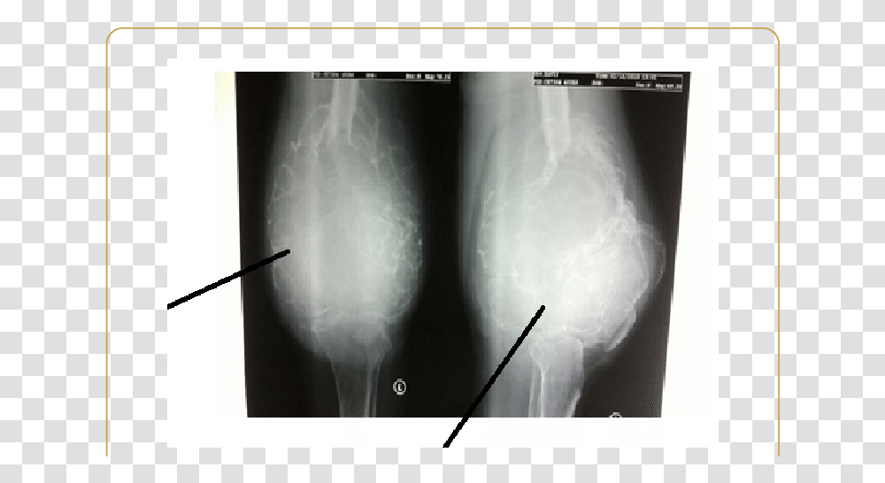 Ap And Lateral Radiographs Of The Left Knee Joint Medical Radiography, X-Ray, Ct Scan, Medical Imaging X-Ray Film, Monitor Transparent Png