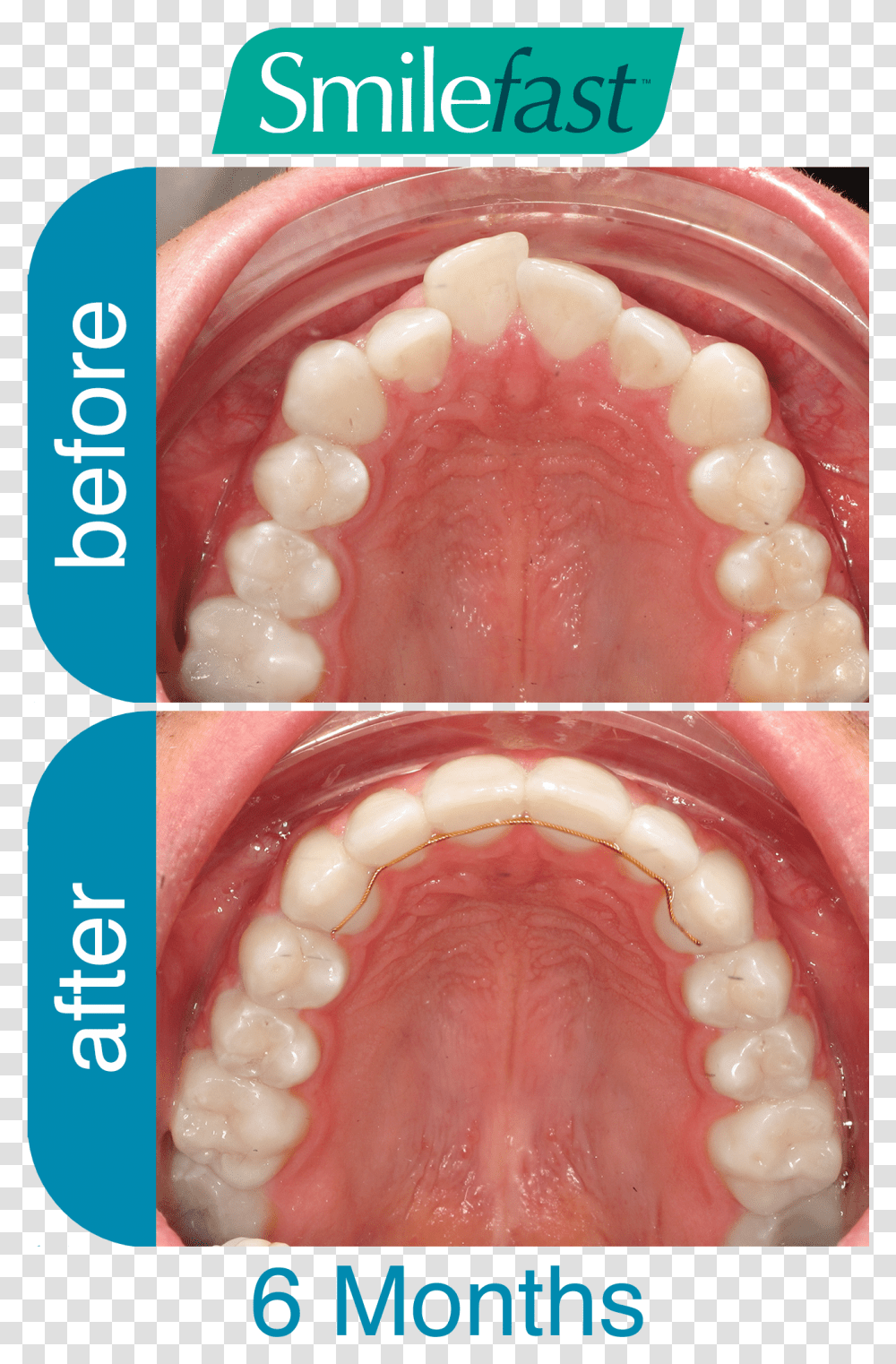 Aqd Smilefast After 6 Months Fast Braces Buck Teeth Before And After, Jaw, Mouth, Lip Transparent Png