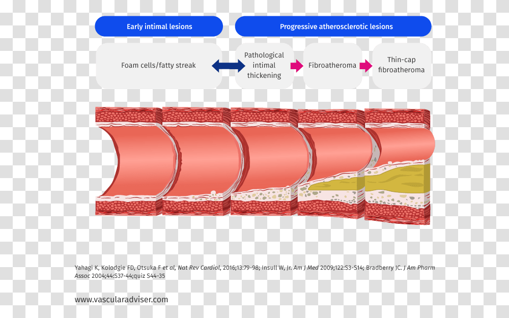 Atherosclerotic Lesion Development Atherosclerosis Lesions, Dynamite, Bomb, Weapon, Weaponry Transparent Png