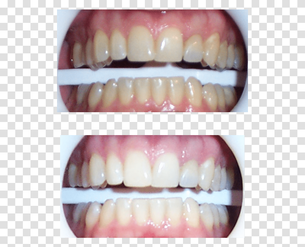 Austin Teeth Whitening Zoom Whitening Before And After, Mouth, Lip, Jaw Transparent Png