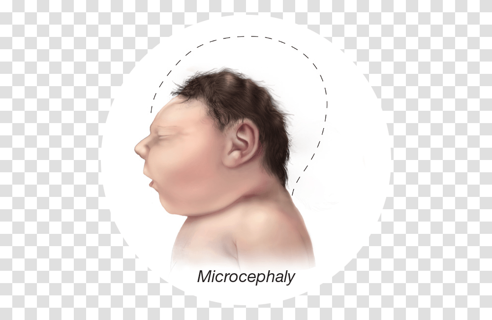 Baby Small Head Zika Baby, Person, Human, Face, Jaw Transparent Png