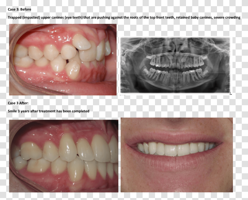 Bad Teeth Braces Before And After, Mouth, Lip, Jaw, Person Transparent Png