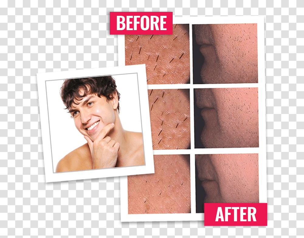 Beard Removal, Skin, Face, Person, Human Transparent Png