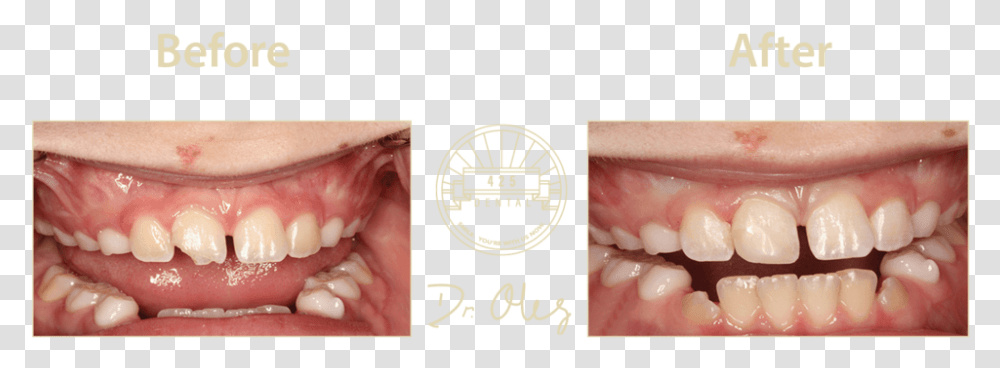 Before After Cosmetic22 Tongue, Jaw, Teeth, Mouth, Lip Transparent Png