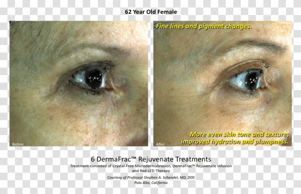 Before Amp After Dermafrac Skin Rejuvenation Injections Poster, Face, Frown, Advertisement, Freckle Transparent Png