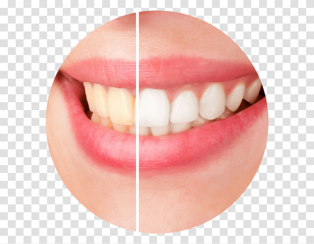 Before And After Teeth Whitening, Mouth, Lip, Person, Human Transparent Png