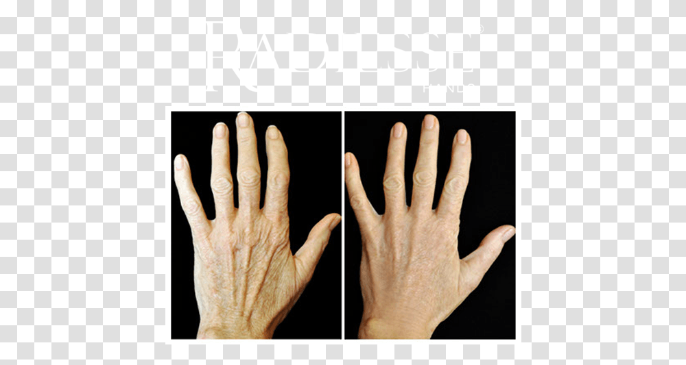 Before And After Treatment With Radiesse Hands Radiesse Hands, Person, Human, Wrist, Face Transparent Png