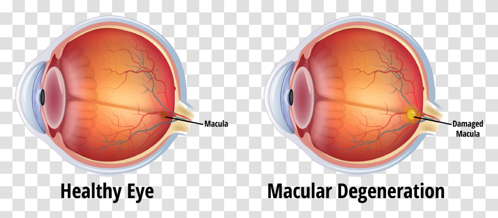 Blindness Caused By Glaucoma, Helmet, Apparel, Head Transparent Png