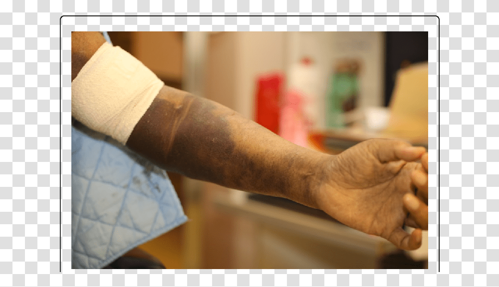 Blood Test Complications Hematoma, Arm, Person, Human, Hand Transparent Png