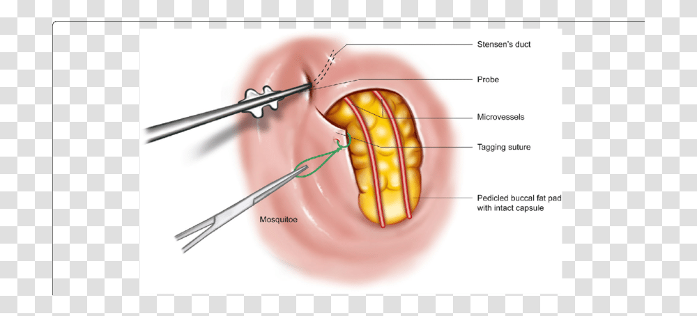 Blunt Fat Herniation Of Buccal Fat Pad, Mixer, Appliance, Mouth, Lip Transparent Png