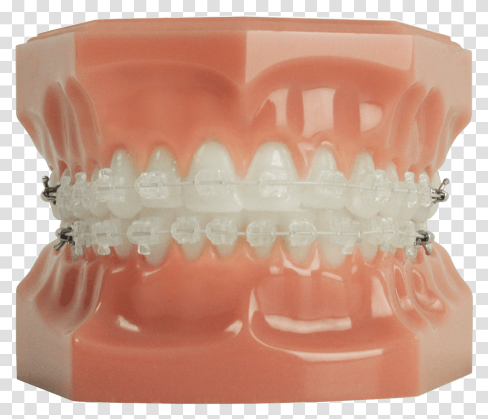 Braces, Jaw, Teeth, Mouth, Lip Transparent Png