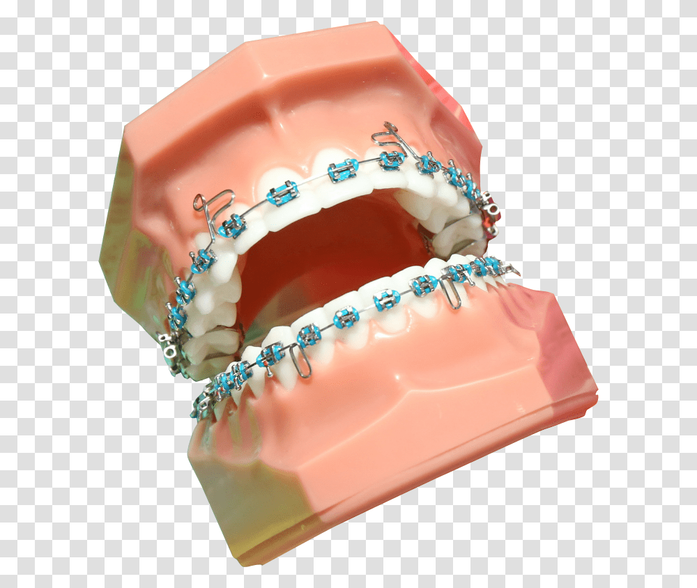 Braces Rodzaje Aparatw Ortodontycznych Staych, Jaw, Teeth, Mouth, Lip Transparent Png