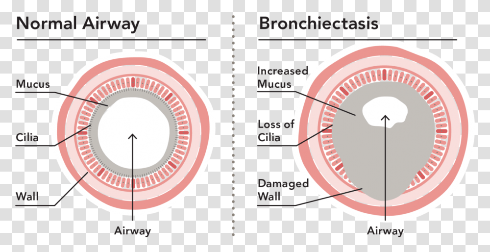 Bronchiectasis Loss Of Cilia, Gauge, Spoke, Plot Transparent Png