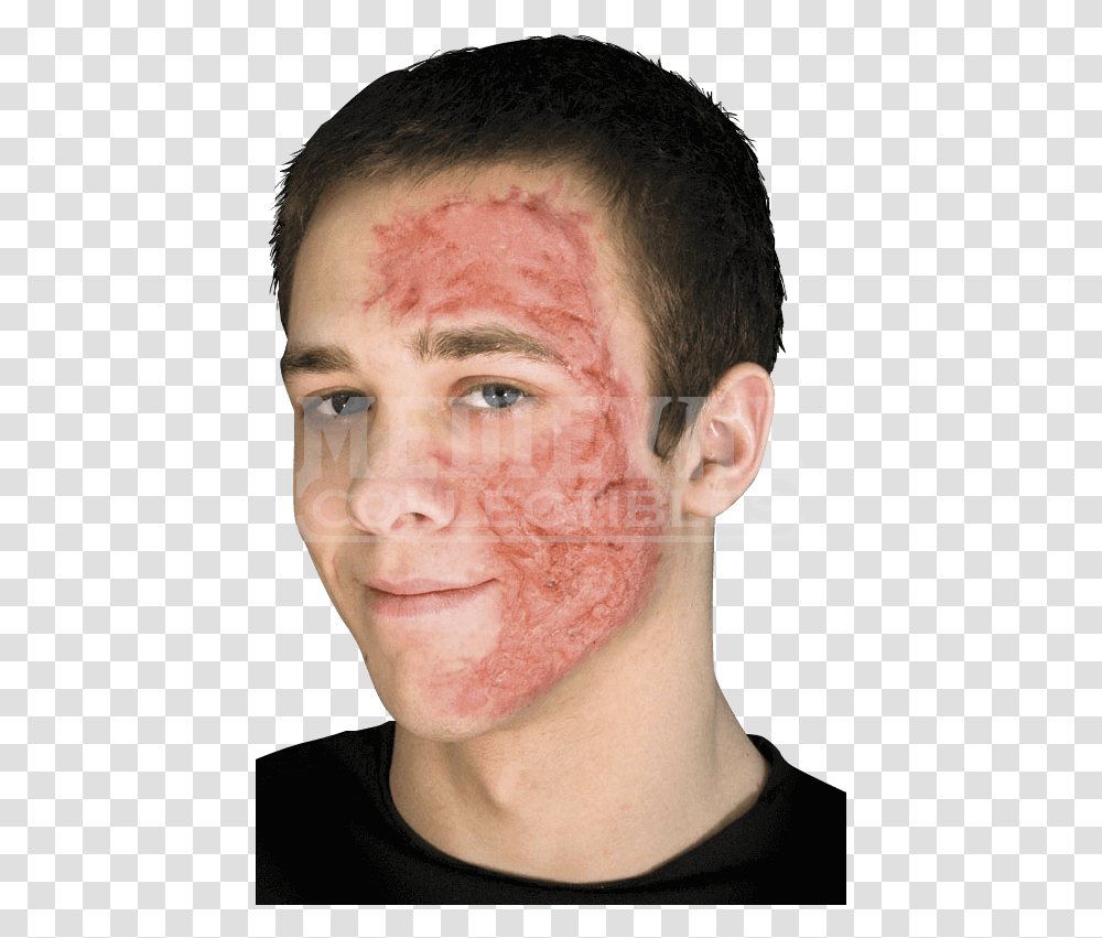 Burn Scar Face Scar On Face From Burn, Person, Human, Skin, Head Transparent Png