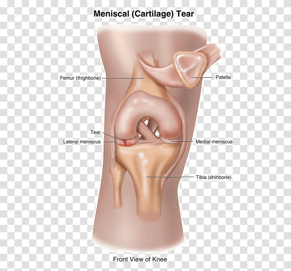 Can A Torn Meniscus Heal Itself Loose Cartilage In Knee, Neck, Diagram, Ear, Plot Transparent Png