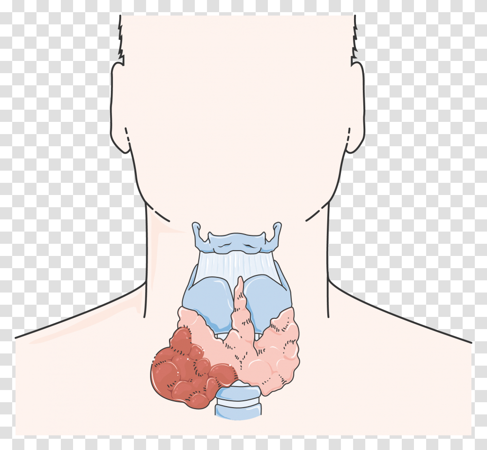 Cancer De La Thyrode Thyroid Cancer Cartoon, Neck, Shoulder, Ankle, Throat Transparent Png