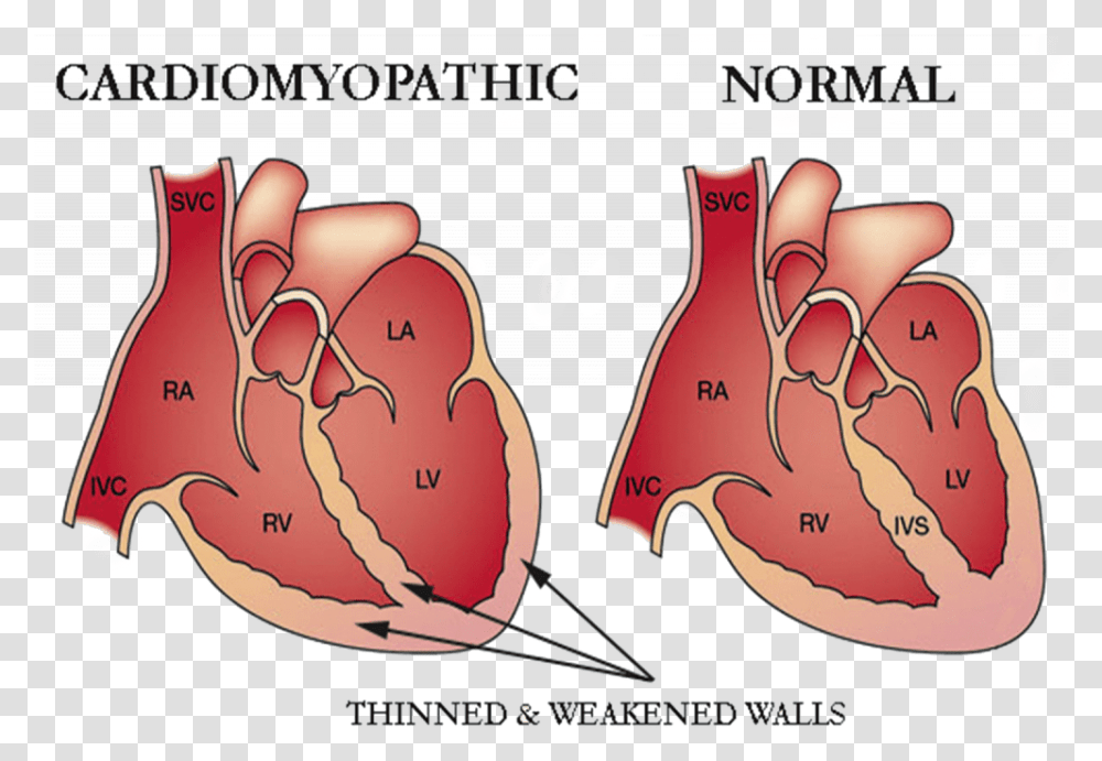 Cardiomyopathy Heart, Hand, Stomach, Plot, Diagram Transparent Png