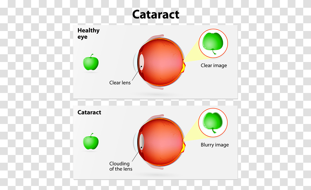 Cataract Cataract Ray Diagrams, Tennis Ball, Sport, Sports, Sphere Transparent Png