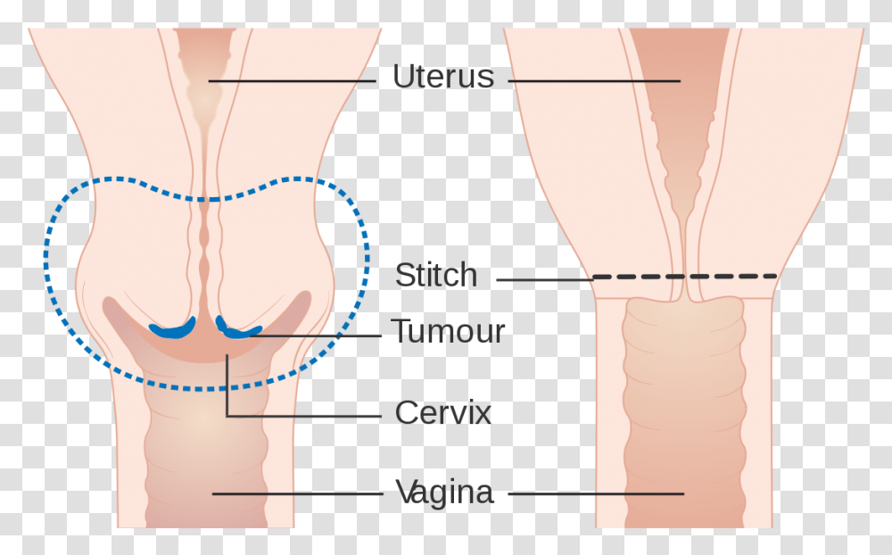 Cervical Amputation Illustration, Plot, Diagram, Neck, Measurements Transparent Png