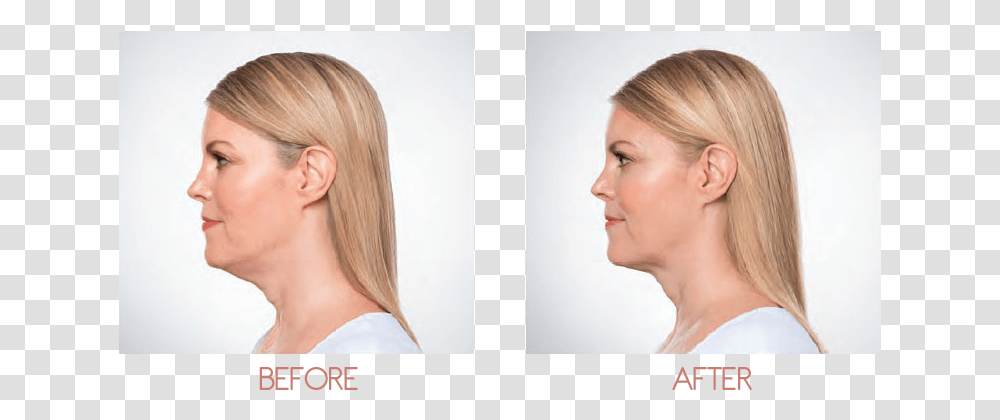 Chin Fat Removal, Face, Person, Human, Jaw Transparent Png