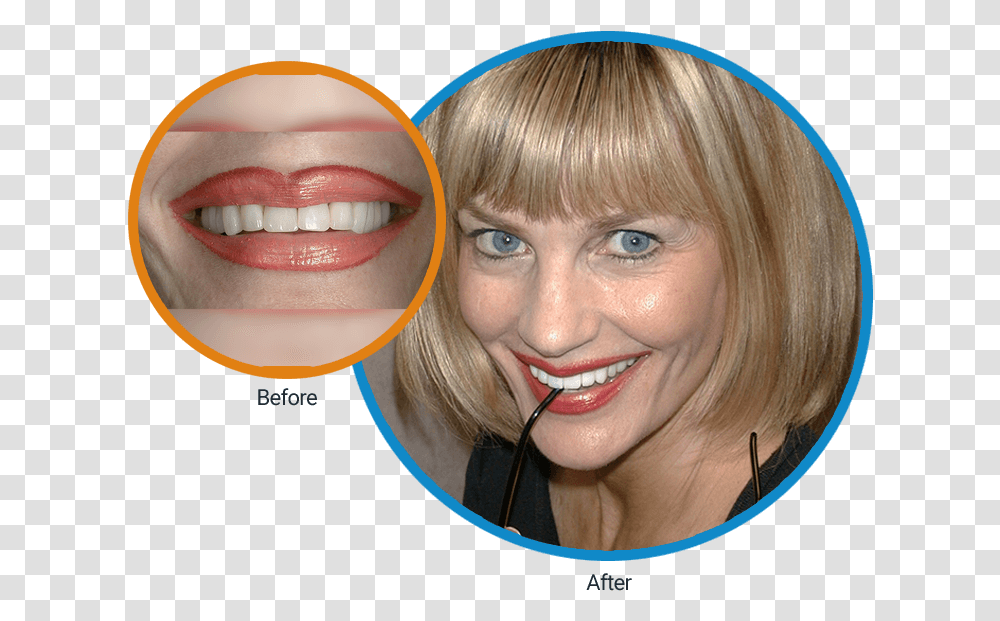 Close Up Before Of Diane S Mouth And Then An After Girl, Teeth, Lip, Face, Person Transparent Png