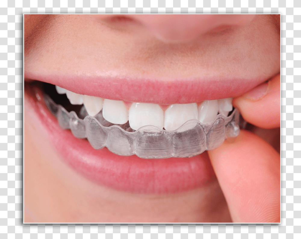 Closeup Of Patient Placing Invisalign Tray Invisalign Braces Cost In India, Teeth, Mouth, Lip, Person Transparent Png