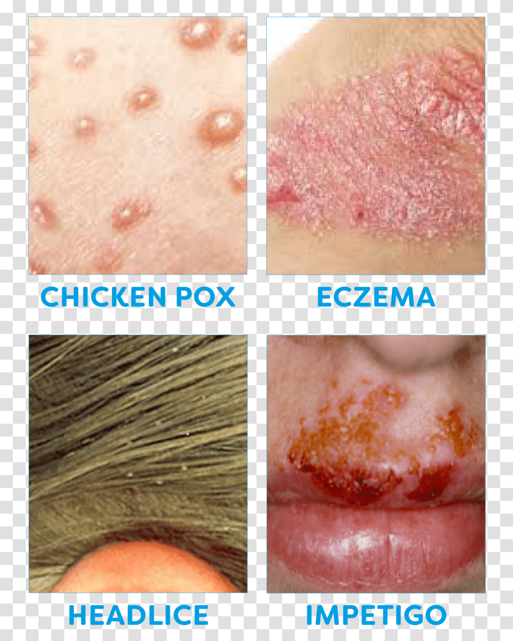 Common Childhood Illnesses 2 Meat, Skin, Mouth, Lip, Face Transparent Png