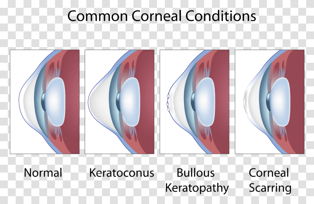 Common Corneal Conditions Keratoconus And Astigmatism, Egg, Food, Electronics, Outdoors Transparent Png
