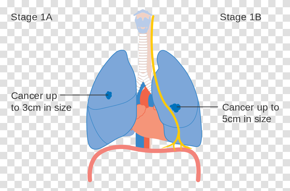 Cough Clipart Lung Cancer, Diagram, Plot, Pattern, Mandolin Transparent Png