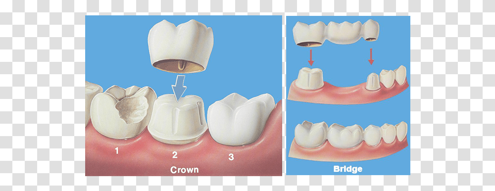Crown Bridge Hobe Sound Dentist Dental Crown And Bridge, Cushion, Birthday Cake, Interior Design, Teeth Transparent Png