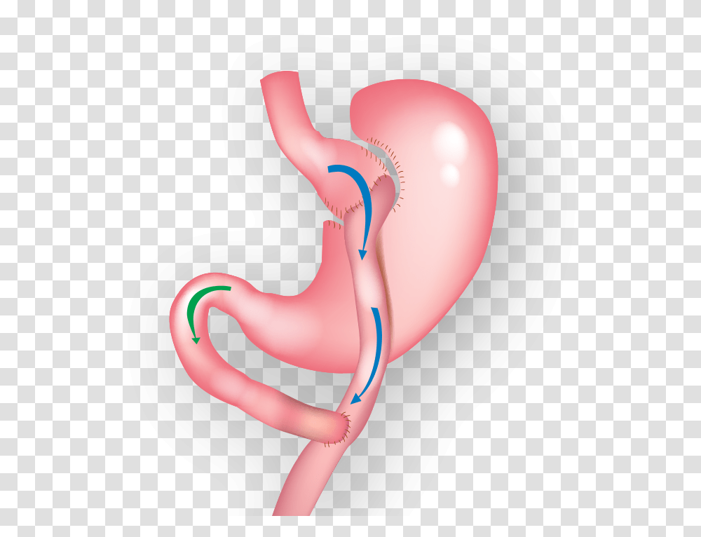 Demonstration Of Gastric Bypass Surgery Gastric Bypass, Stomach, Person, Human, Heart Transparent Png
