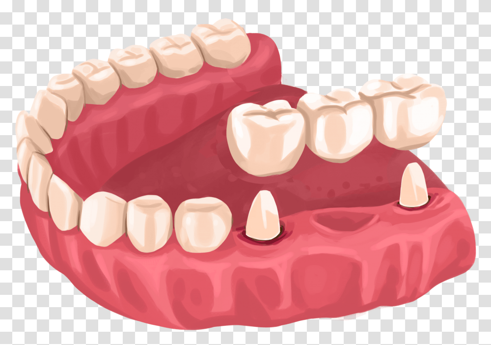 Dental Bridge, Teeth, Mouth, Lip, Birthday Cake Transparent Png