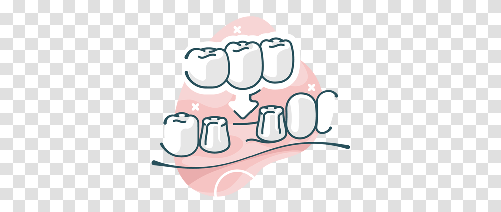 Dental Bridges Fist, Hand, Teeth, Mouth, Lip Transparent Png