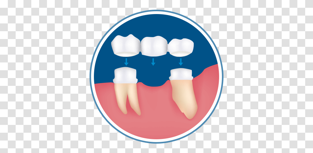 Dental Crowns Bridges In San Antonio Vertical, Teeth, Mouth, Lip Transparent Png