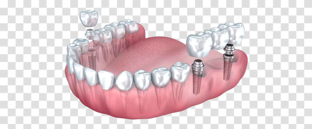 Dental Implant Benefits Summit Nj Multiple Dental Implants, Teeth, Mouth, Lip, Jaw Transparent Png