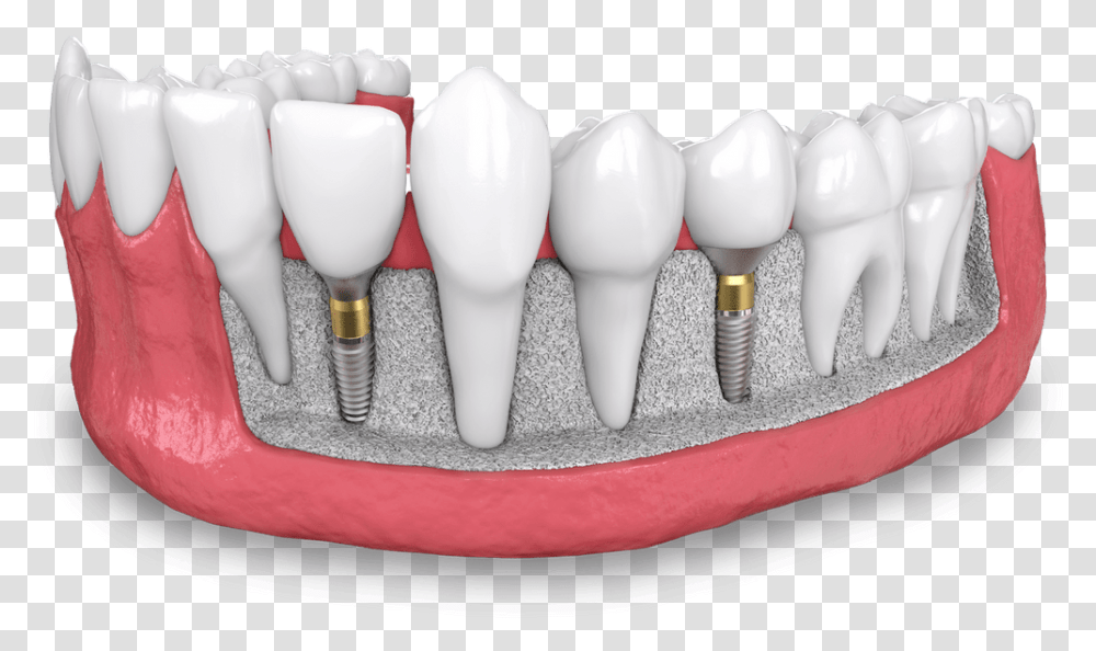 Dental Implant Model Dana Point Ca Dental Implant, Light, Lightbulb, Porcelain Transparent Png